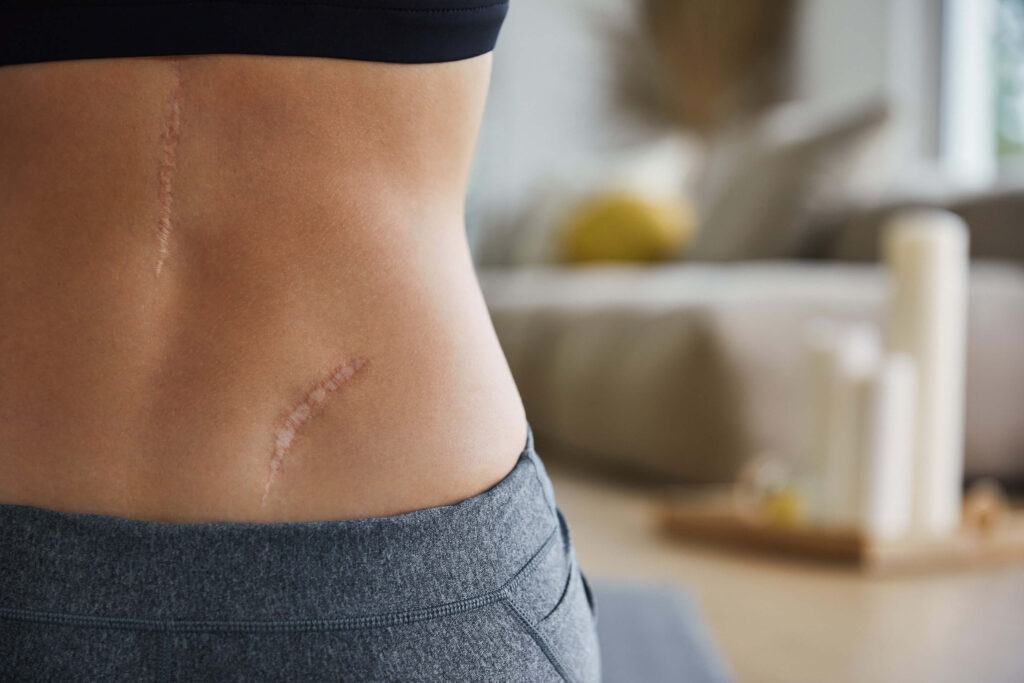 как да се справим с белезите