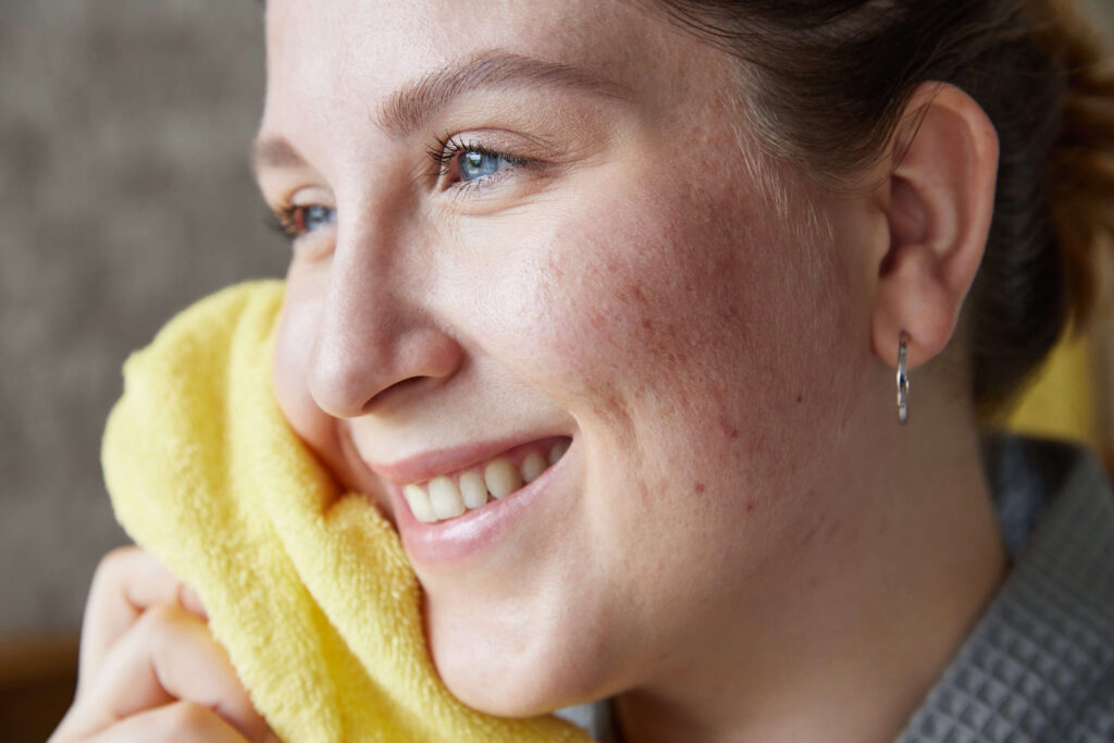 белези от акне